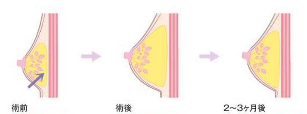 抽脂填胸多少錢？請(qǐng)問(wèn)抽脂填胸需要做二填嗎？