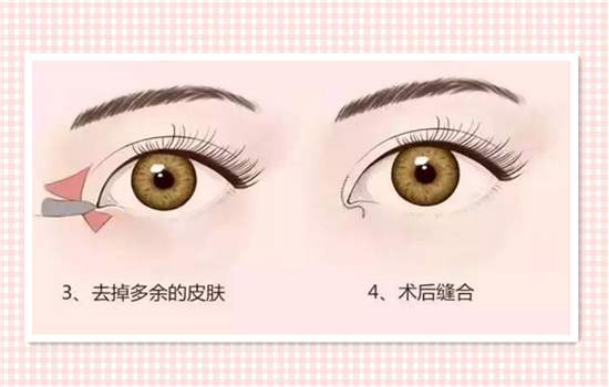 開內(nèi)眼角哪里好？想要做開眼角手術(shù)該如何選擇醫(yī)院