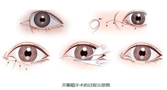 開內(nèi)眼角哪里好？想要做開眼角手術(shù)該如何選擇醫(yī)院
