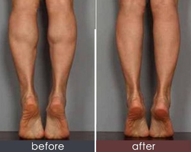 注射瘦臉瘦小腿可以瘦幾厘米？要注射多少單位？