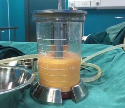 環(huán)形抽脂有什么危害嗎？告別“五花肉”還是抽脂好