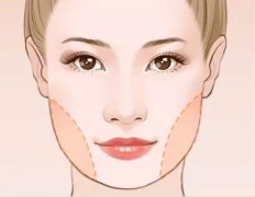 做完面部抽脂手術(shù)多久能恢復(fù)？恢復(fù)期的注意事項~