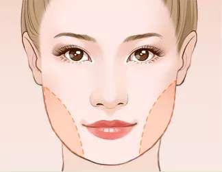 做完面部抽脂手術(shù)多久能恢復(fù)？恢復(fù)期的注意事項~