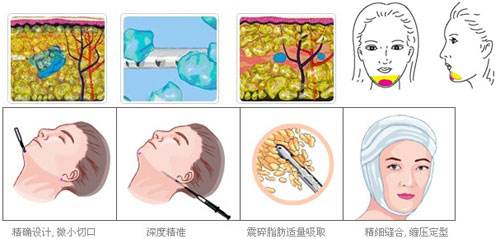 做完面部抽脂手術(shù)多久能恢復(fù)？恢復(fù)期的注意事項~