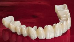 美容冠多少錢一顆？美容冠的缺點(diǎn)讓牙齒成為不可逆的傷害