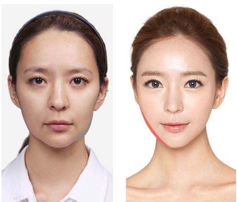 了解到韓國面部提升在當(dāng)?shù)睾芑穑敿氈v解一下這個手術(shù)！