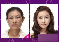 大臉盤子做削骨要多少錢？削骨手術(shù)的死亡率大嗎？