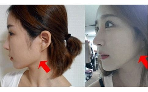 大臉盤子做削骨要多少錢？削骨手術(shù)的死亡率大嗎？