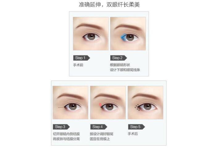 微創(chuàng)開眼角多少錢？盤點一下微創(chuàng)開眼角是什么技術(shù)