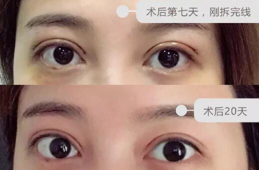 雙眼皮案例：