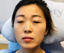 法令紋太深！玻尿酸鼻唇溝填充術(shù)后果反饋