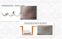 好幾年的痘印做微針痘坑幾次有？祛痘指南請收好