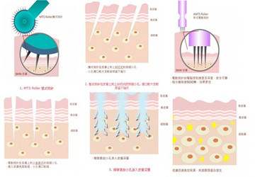 好幾年的痘印做微針痘坑幾次有？祛痘指南請收好