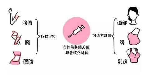 關(guān)于面部填充手術(shù)：