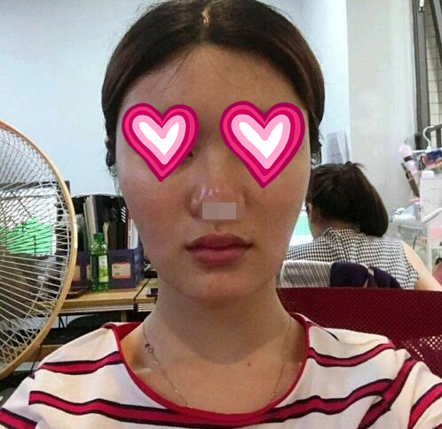 廣西中醫(yī)藥大學(xué)第一附屬醫(yī)院整形案例