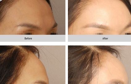 額頭窄豐額頭多少錢？哪些方法沒問題又有？