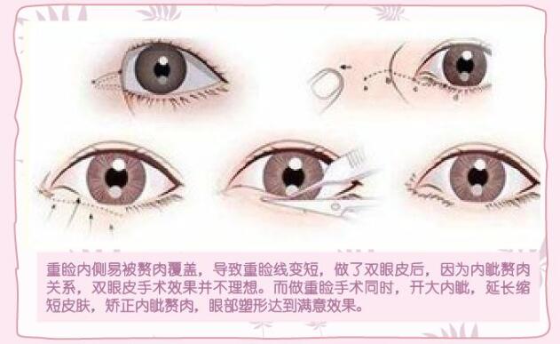 眼睛整形要多少錢？眼部綜合整形手術能改良的問題