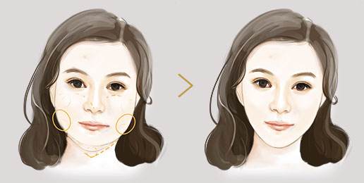 你打完注射瘦臉果不太好？這類臉型這樣打注射瘦臉果才好！