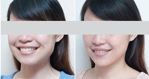 你打完注射瘦臉果不太好？這類臉型這樣打注射瘦臉果才好！