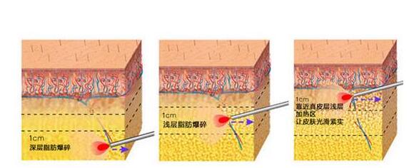 大腿臀部吸脂手術(shù)需要去公立醫(yī)院嗎?