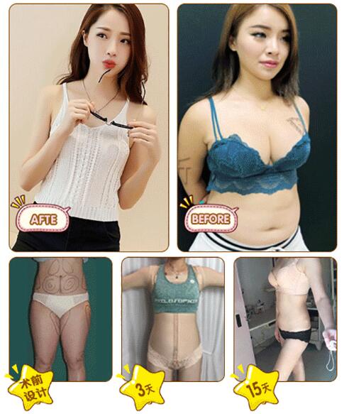 腰部吸脂減肥手術(shù)恢復(fù)期注意事項(xiàng)