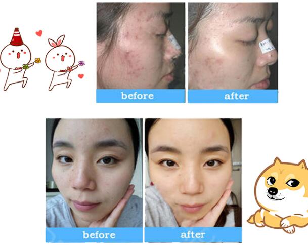 果酸煥膚是怎么回事？“換”掉的到底是什么？