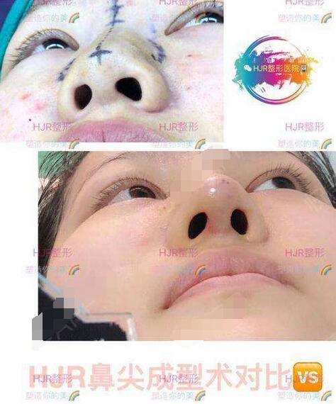 鼻頭鼻翼縮小整形手術(shù)果圖