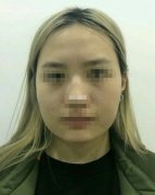 小姐姐做的下頜角長弧度截骨案例，來更新啦…