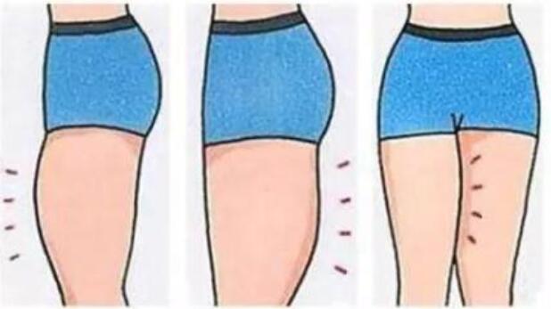 大腿肉注射瘦腿能打嗎?脂肪多打注射瘦腿是浪費(fèi)錢!
