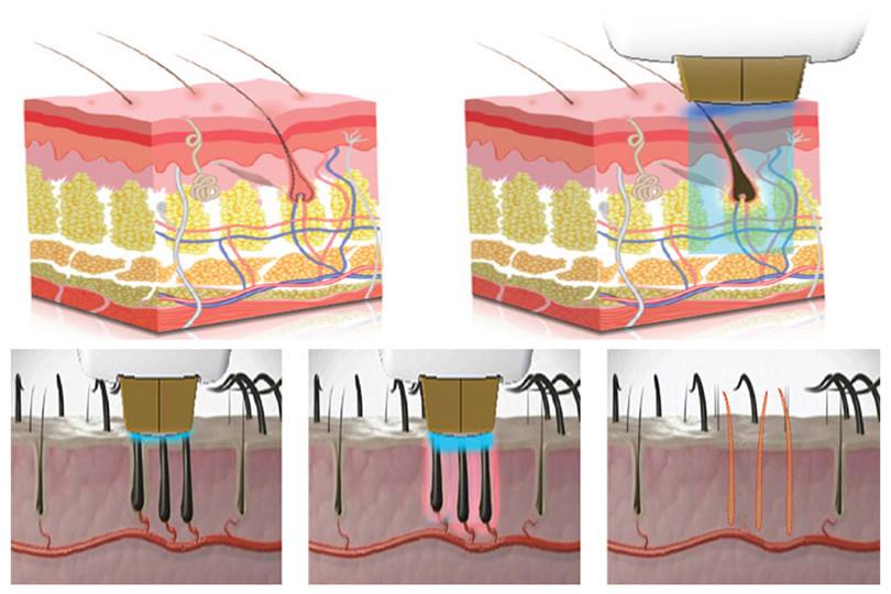 絡腮胡子怎么去除？可以做激光脫毛手術嗎？