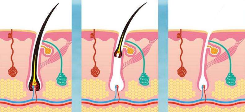 絡腮胡子怎么去除？可以做激光脫毛手術嗎？