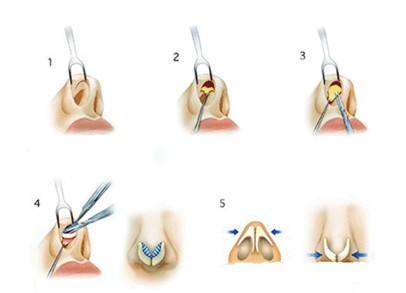 假體隆鼻手術(shù)沒(méi)問(wèn)題嗎？術(shù)前詳細(xì)了解少走彎路