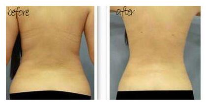 吸脂手術到底是怎樣的?