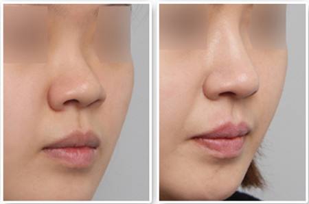 鼻子注射玻尿酸的間隔時間多長才好？