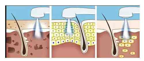 做光子嫩膚美容真的能提升膚質(zhì)嗎？看看果圖
