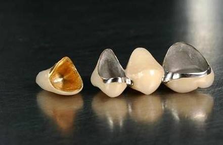 種類(lèi)太多，來(lái)講講鈷鉻合金烤瓷牙的優(yōu)缺點(diǎn)