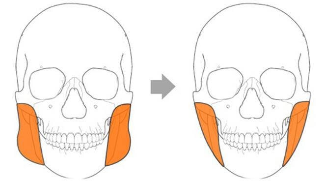 下頜角太肥？咬肌切除手術(shù)說(shuō)不定就能搞定
