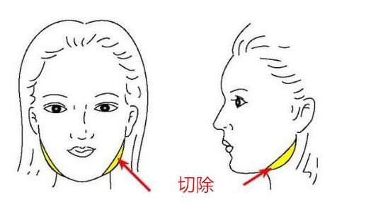 下頜角太肥？咬肌切除手術(shù)說(shuō)不定就能搞定