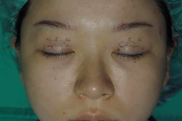 眼皮太厚 做雙眼皮手術需要吸脂嗎