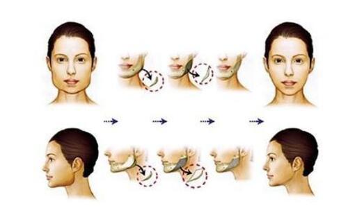 臉盤子大，臉部輪廓整形手術(shù)的果了解一下！