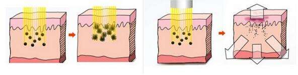 黃褐斑怎么消除？有辦法嗎？聽說黃褐斑很難除掉