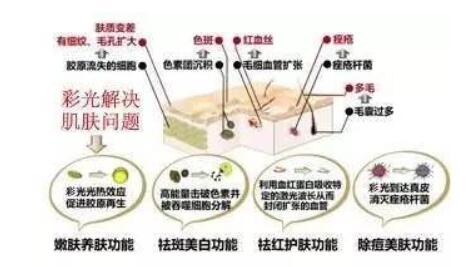 看似很沒(méi)問(wèn)題？彩光嫩膚副作用竟然有這些