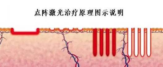 多年痘痘肌，脈沖激光祛痘能徹底治好痘痘和痘印嗎？