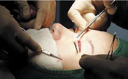 做了激光近視矯正還能做雙眼皮手術(shù)嗎？