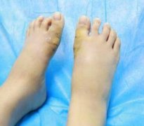 大腳骨手術(shù)親身經(jīng)歷：術(shù)后恢復(fù)果還不錯(cuò)(圖)