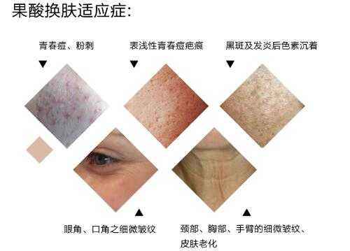 什么是果酸換膚？果酸換膚的功和適宜膚質(zhì)你造嗎
