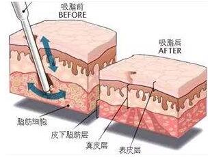 手臂吸脂手術(shù)的果好么?