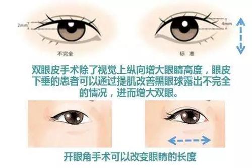 做雙眼皮開眼角為什么要一起做？可能是這個(gè)原因