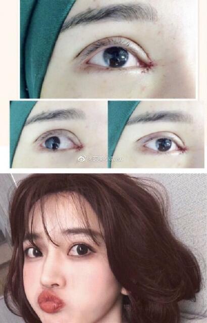 鄭美善雙眼皮案例