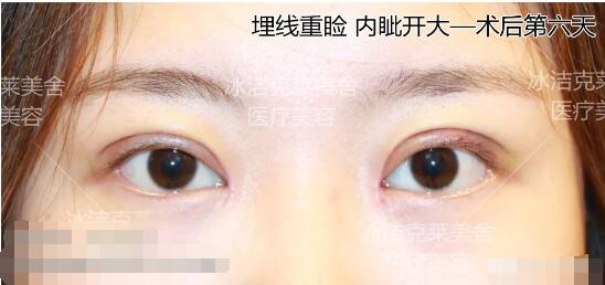 張冰潔埋線雙眼皮 開眼角術后果圖